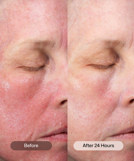 RS_cmt_post_procedure_cream_4.jpg RS_cmt_post_procedure_cream_4.jpg